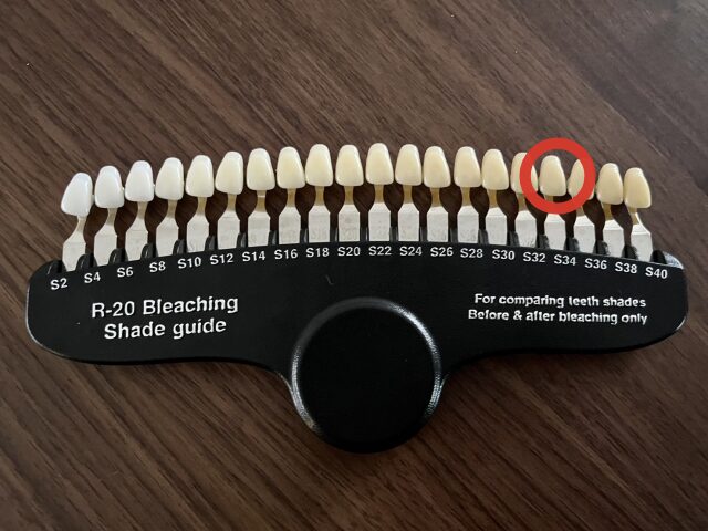 【矯正中でもできる?】15万円ホワイトニングの効果と後悔しなかった理由を本音で語る