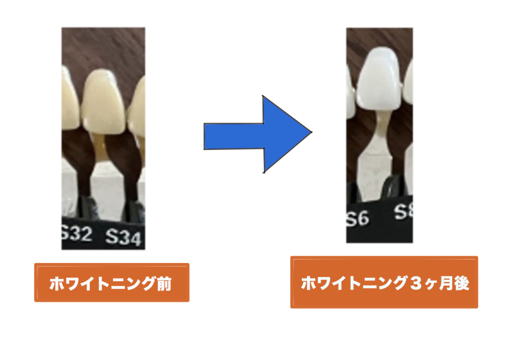 【矯正中でもできる?】15万円ホワイトニングの効果と後悔しなかった理由を本音で語る