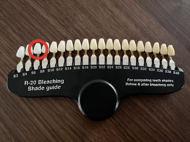 【矯正中でもできる?】15万円ホワイトニングの効果と後悔しなかった理由を本音で語る